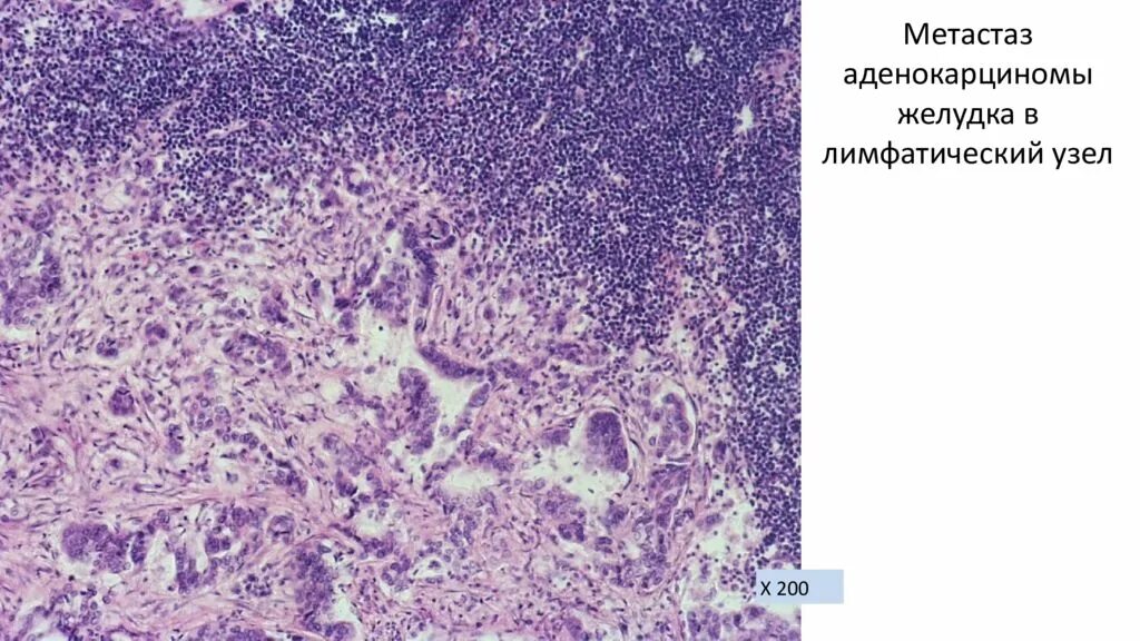 Метастазы лимфоузлы форум. Аденокарцинома желудка гистология. Низкодифференцированная аденокарцинома желудка гистология. Аденокарцинома печени гистология. Метастаз в лимфоузел микропрепарат.