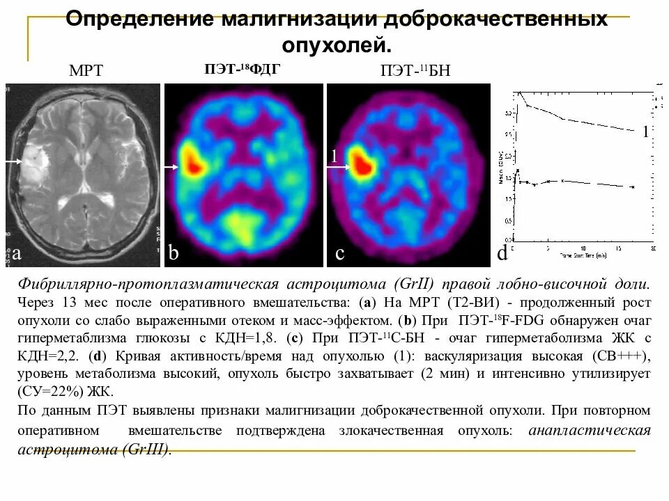 ПЭТ кт накопление ФДГ. ПЭТ-кт головного мозга с 18 ФДГ. ПЭТ кт головной мозг с ФДГ. Метаболическая активность на пэт