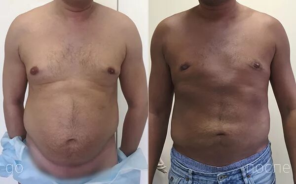 липосакция для мужчин