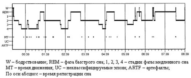 Гипнограмма стадии сна. Фазы сна схема. Схема цикла сна. Фазы сна диаграмма.