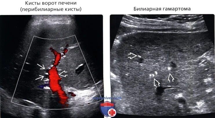 Образование в воротах печени. Кистозные образования печени анэхогенное. Перибилиарные кисты печени. Кистозные образования печени.