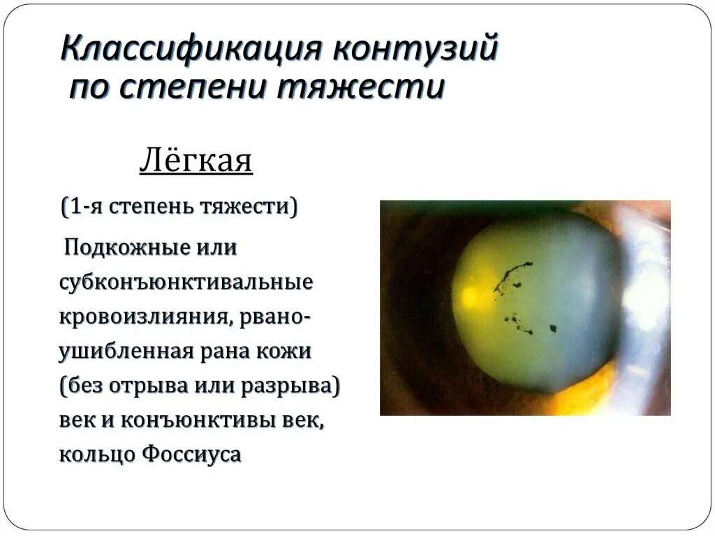 Что такое контузия словами и последствия. Классификация контузии глазного яблока по степени тяжести. Контузия глаза по степени тяжести. Контузия степени тяжести. Контузия 2 степени тяжести.