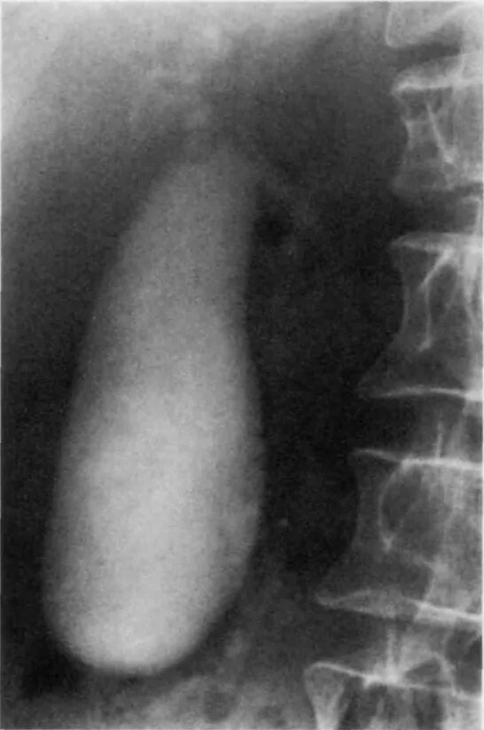 Пероральная холецистография. Холецистография желчного пузыря. Холецистография рентген. Рентгенограмма желчного пузыря.