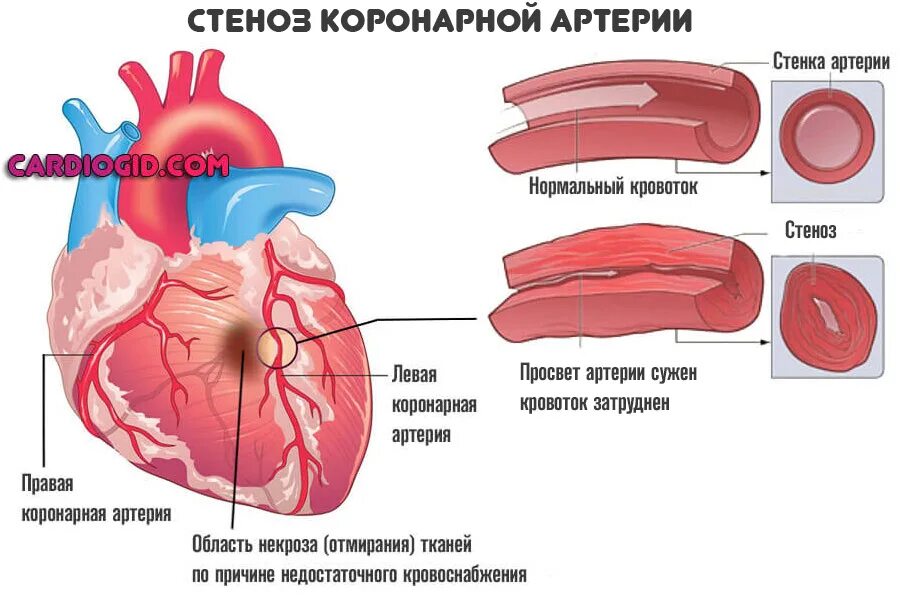 Сердечный стеноз. Стеноз коронарных артерий. Атеросклеротическое сужение коронарных сосудов. Коронарные артерии сердца. Стенозирование коронарной артерии.