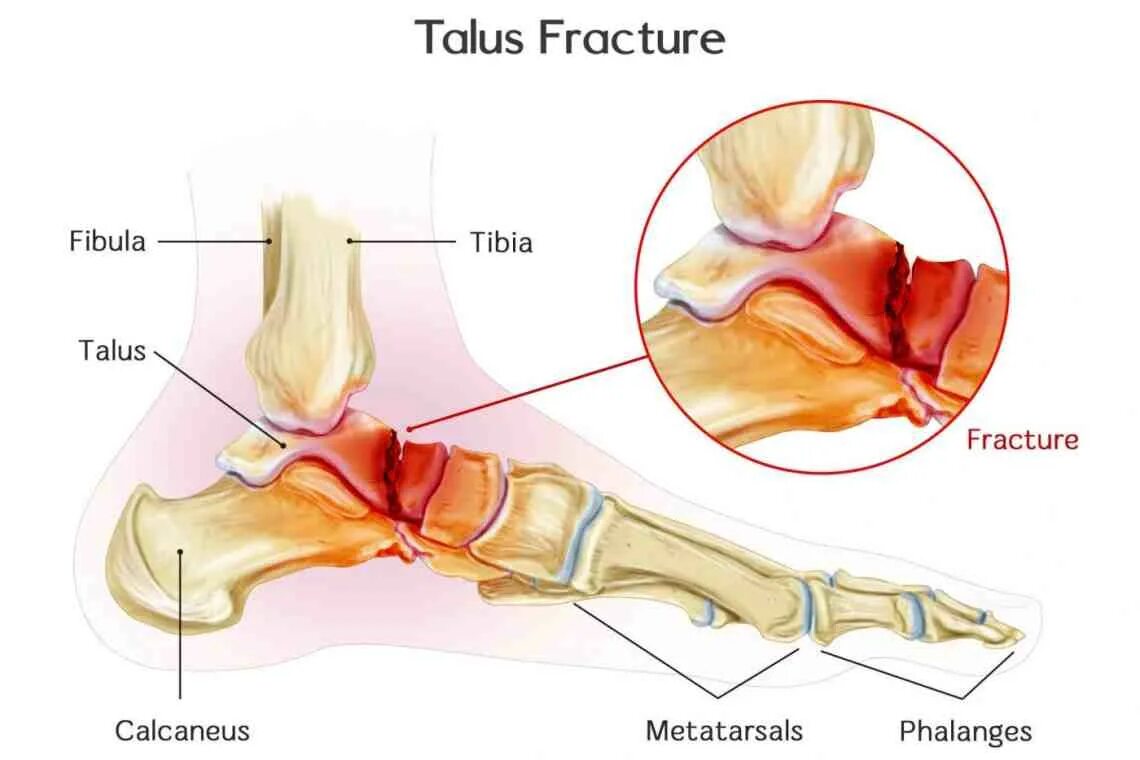 Перелом кости может быть каким. Talus кость. Таранная кость.