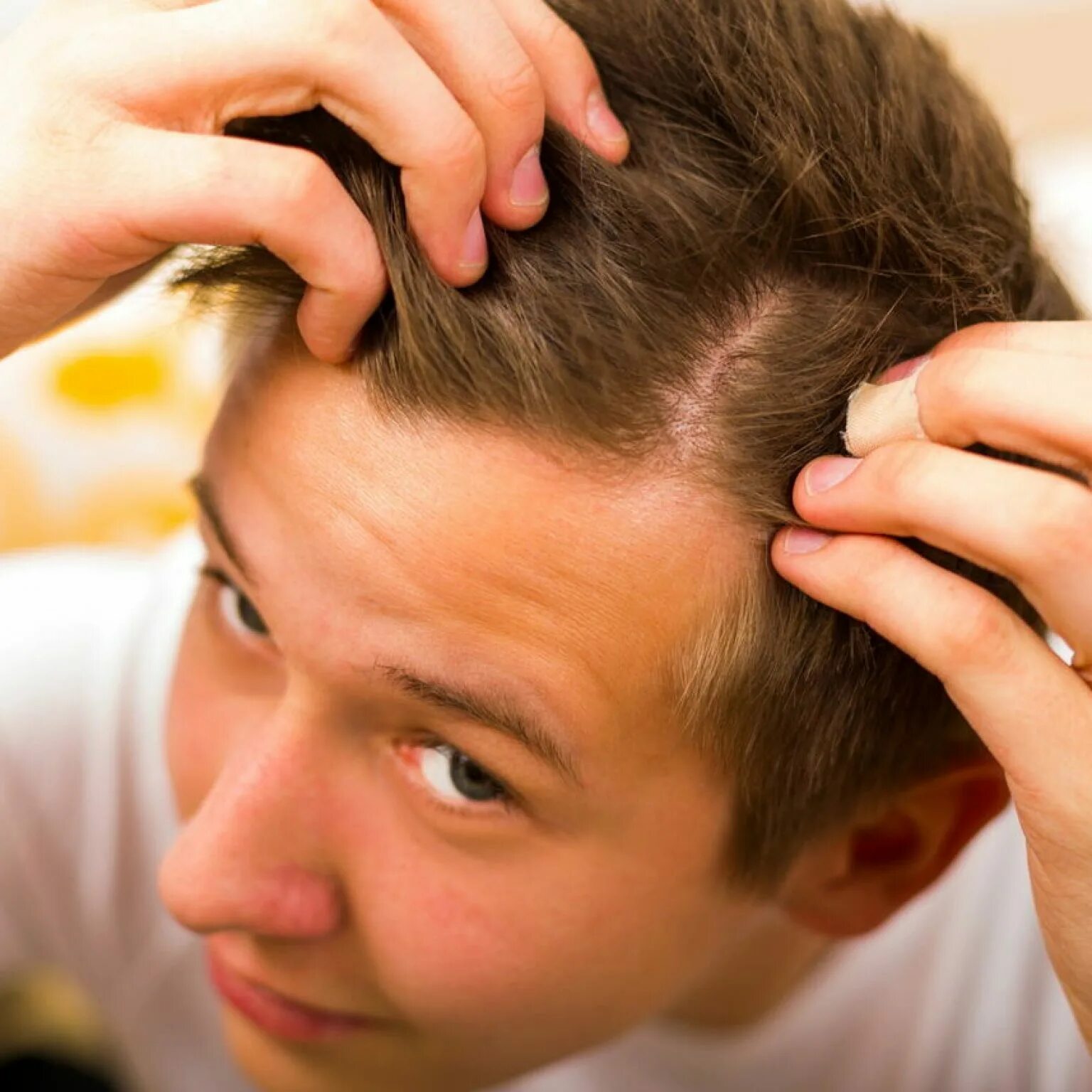 Причины выпадения волос у подростка. Поредение волос у мужчин. Облысение у подростков на голове.