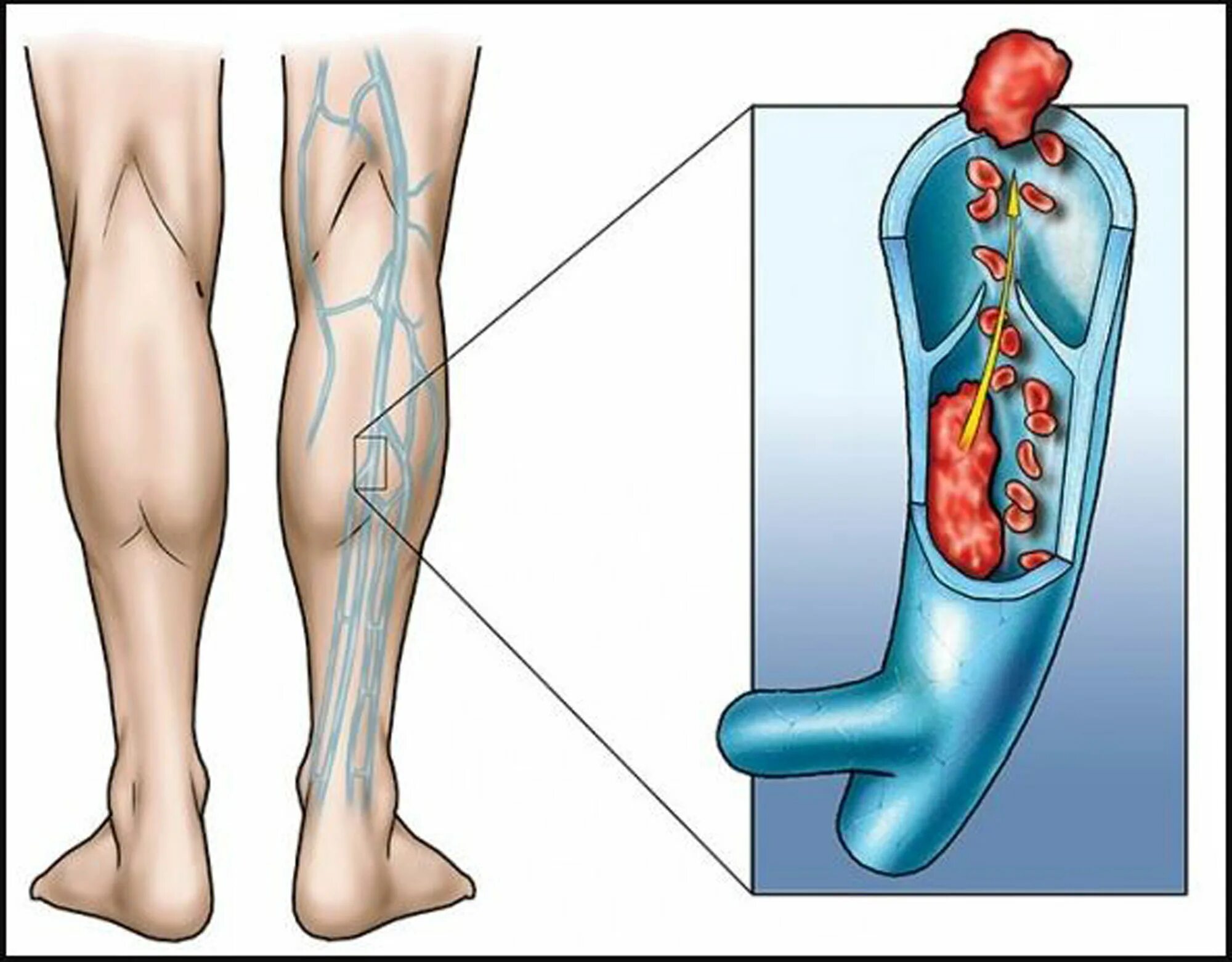 Венозный тромбоз глубоких вен нижних конечностей. Илеофеморальный венозный тромбоз. Варикозное расширение вен (ВРВ) нижних конечностей. Нарушение кровообращения хирургия