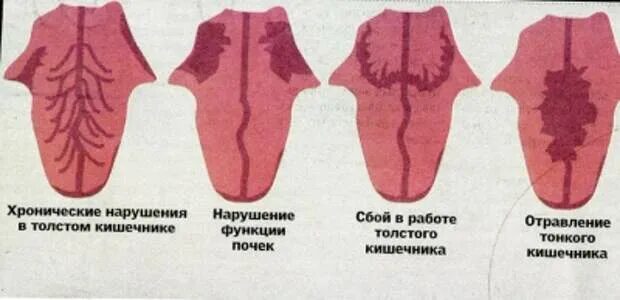 Географическая форма языка. Заболевания по цвету языка. выявление заболевания по языку. заболевания по состоянию языка. болезни по языку определить.