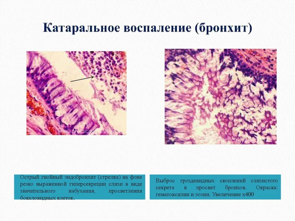 Воспаление серозной оболочки. Катаральное воспаление патанатомия. Катаральная пневмония патанатомия. Хроническое воспаление патанатомия Патан. Катаральное воспаление микропрепарат.