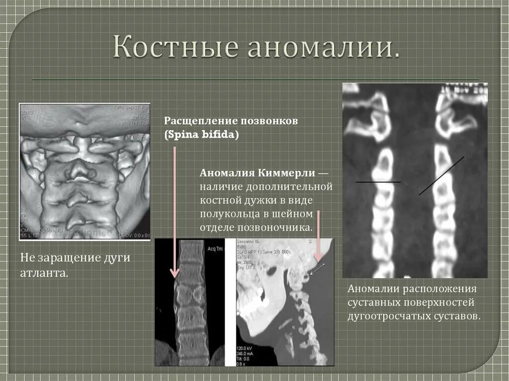 Аномалии развития позвоночника. Аномалия развития позвонка с1 Киммерли. Аномалия Киммерли клинические рекомендации. Аномалия Киммерли в шейном отделе кт.