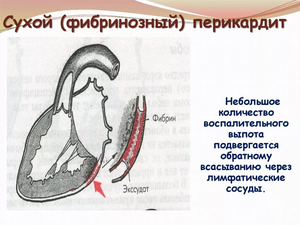 Сухой перикардит. Сухой и экссудативный перикардит. Перикардит сухой и выпотной. Сухой фибринозный перикардит.