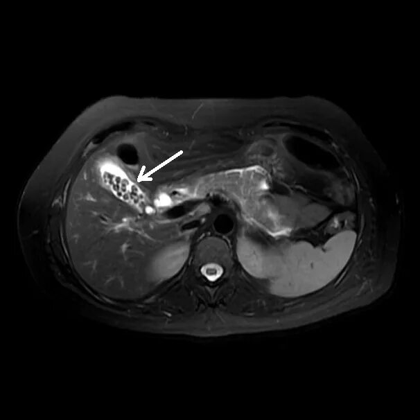 Желчекаменная болезнь мрт. Калькулезный холецистит кт. Желчекаменная болезнь кт. Камни в желчном кт