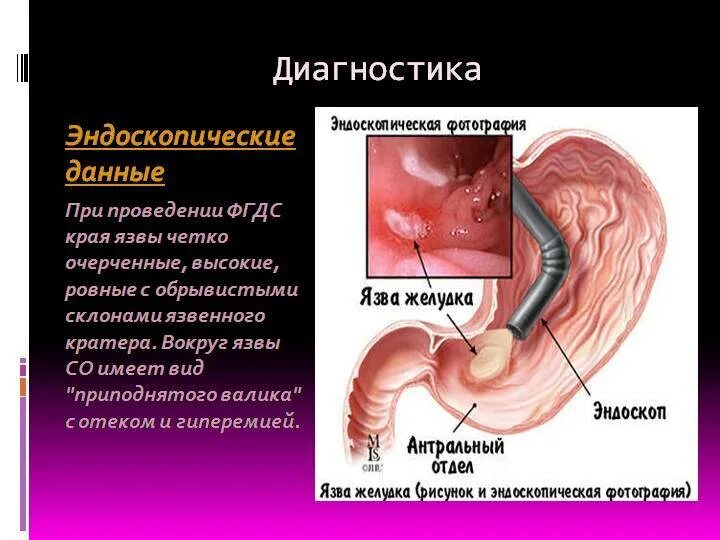 Как проверить язву