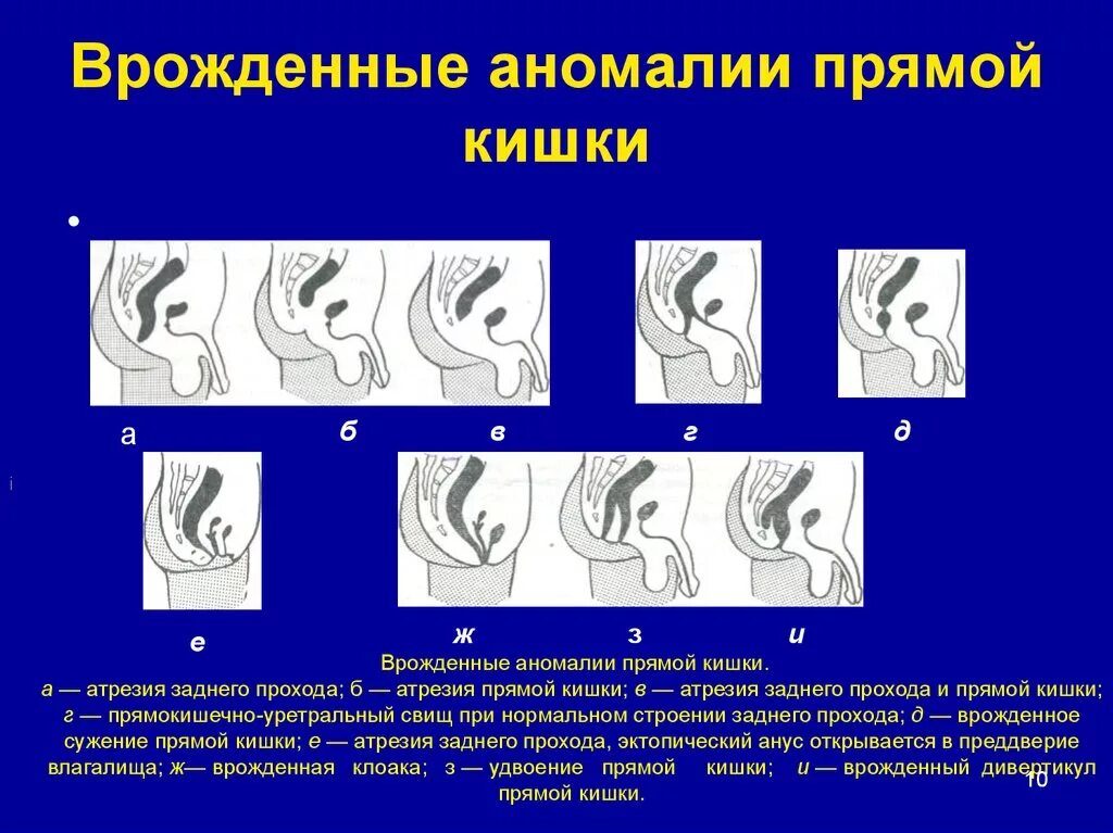 Аномалии развития нерва. Пороки развития прямой кишки атрезия. Аномалии развития анального отверстия. Аноректальных аномалий развития. Анорексиальнып пороки развития.