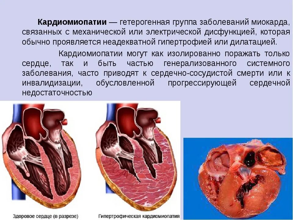 Клинические симптомы кардиомиопатии. Дилатационная и гипертрофическая кардиомиопатия. Кардиопатия гипертрофия. Гипертрофическая кардиомиопатия макропрепарат.