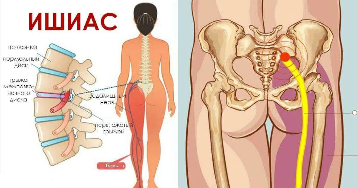 Седалищный нерв. Ишиас седалищного нерва. Защемление седалищного нерва упражнения. Гимнастика защемило седалищный нерв. Нерв в правой ягодице