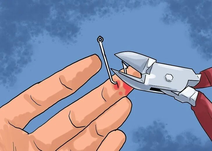 Как вытащить рыболовный крючок из пальца. Как вытащить рыболовный крючок из пальца. Как достать пальцем. Как достать пальцем. Вытащить крючок из пальца.