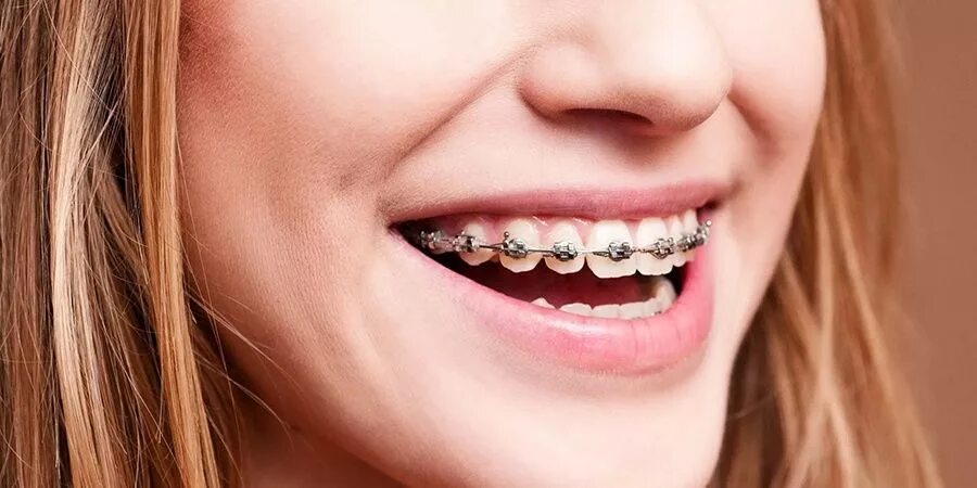 Металлические лигатурные брекеты. Брекета 25. Брекеты h4 самолигирующие металлические. Dynaflex mtx брекеты. Самолигирующие (безлигатурные) брекеты.