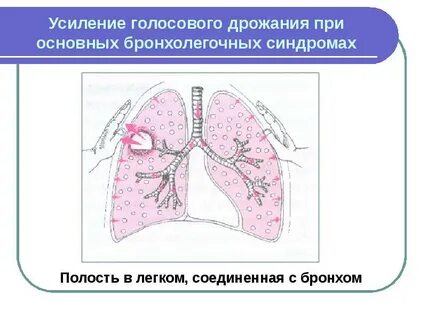 Усиление голосового дрожания