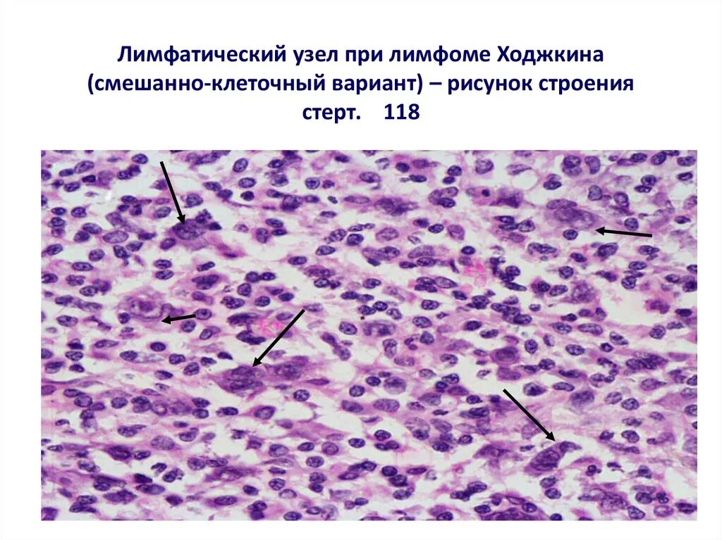 Лимфогранулематоз лимфома Ходжкина микропрепарат. Клетки Березовского-Штернберга гистология. Лимфома Ходжкина гистология. Жидкость в лимфоузле