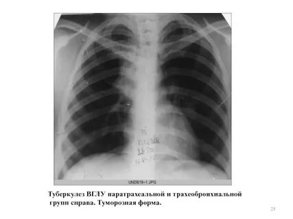 Туберкулез лимфоузлы легких