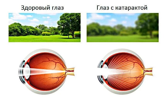 Как выглядит хрусталик глаза при катаракте Катаракта глаз: симптомы, профилактика, лечение "Рита Спарк"/"Зеркальный", Ека
