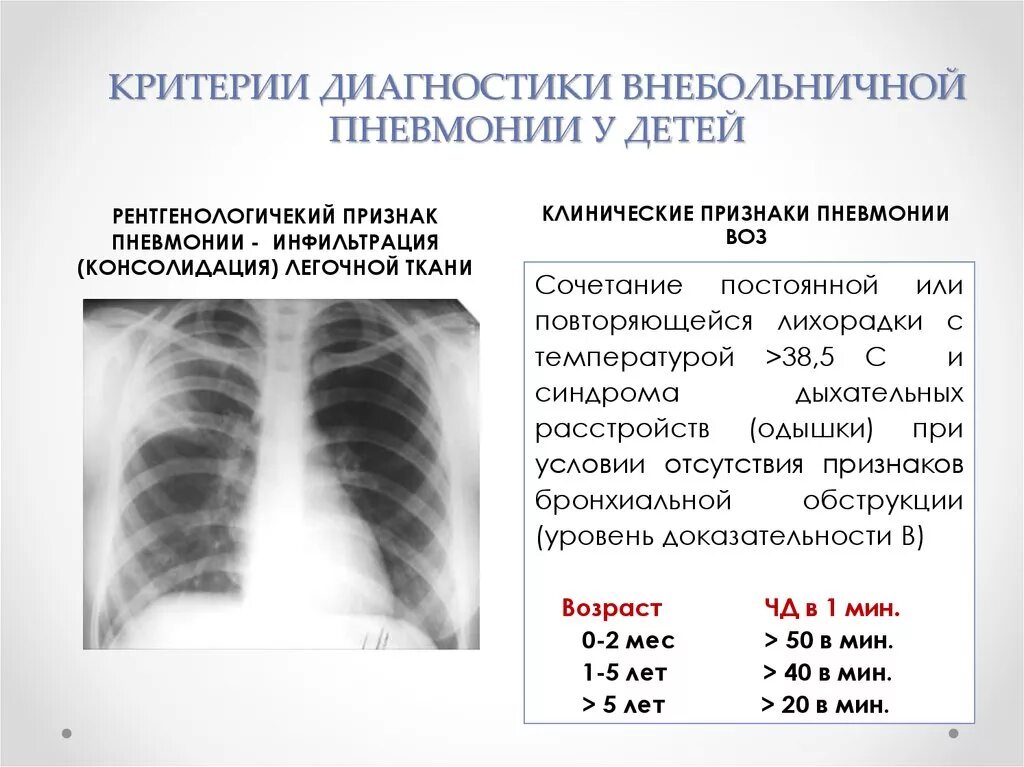 Чем грозит пневмония. Пневмония у ребенка 3 года рентген. Диагностические признаки пневмонии. Внебольничная пневмония рентген. Рентген при внебольничной пневмонии.