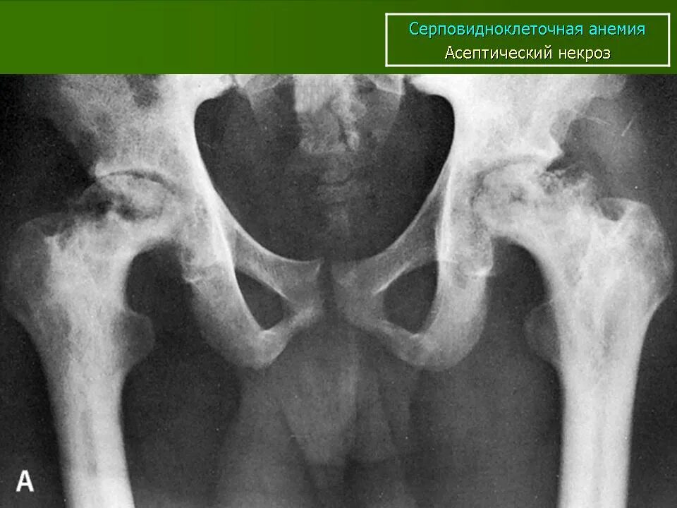 Асептический некроз без операции. Асептический некроз бедренных костей. Асептический некроз кости. Асептический некроз кт.