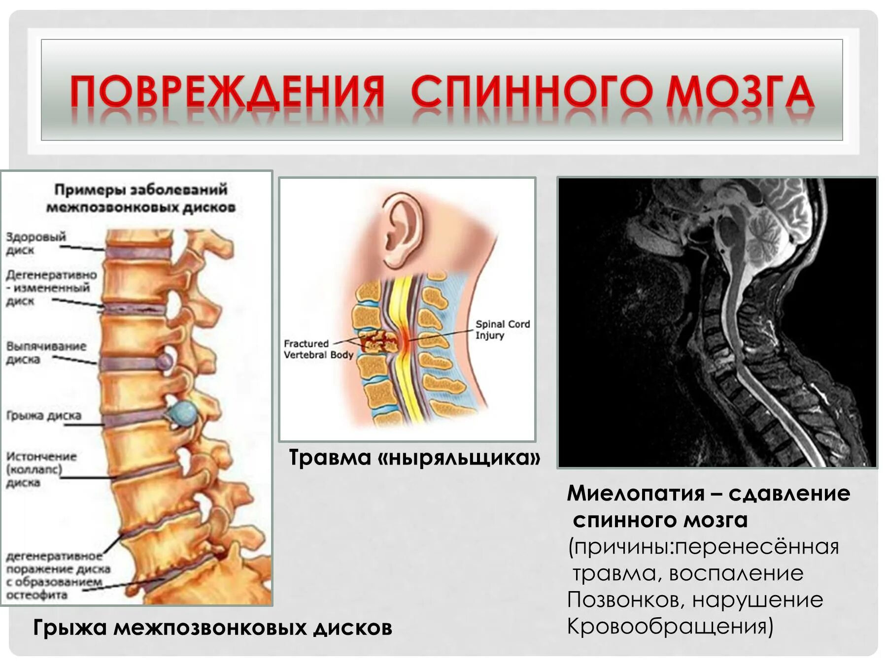 Компрессия спинного мозга при переломе позвоночника. При повреждениях спинного мозга. Осложнения. Компрессия спинного мозга травма шейный отдел позвоночника. Признаки повреждения спинного мозга.