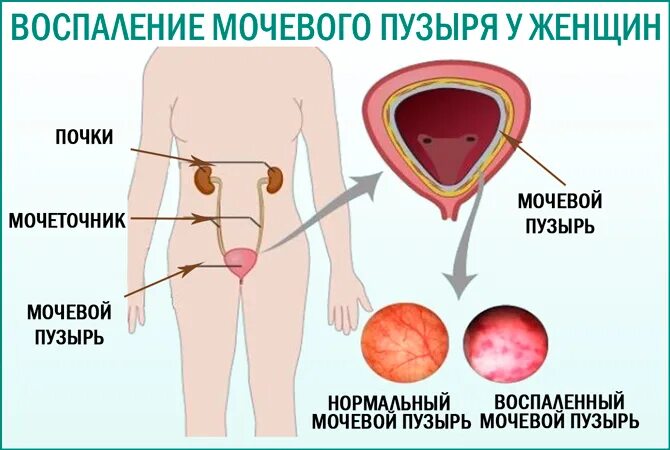 Воспаление мочевого пузыря у женщин лечение. Воспаление мочевого пузыр. воспаление мочевого пузыря у женщин. воспаление мочевого пузыря у женщин симптомы. воспаленный мочевой пузырь у женщин.