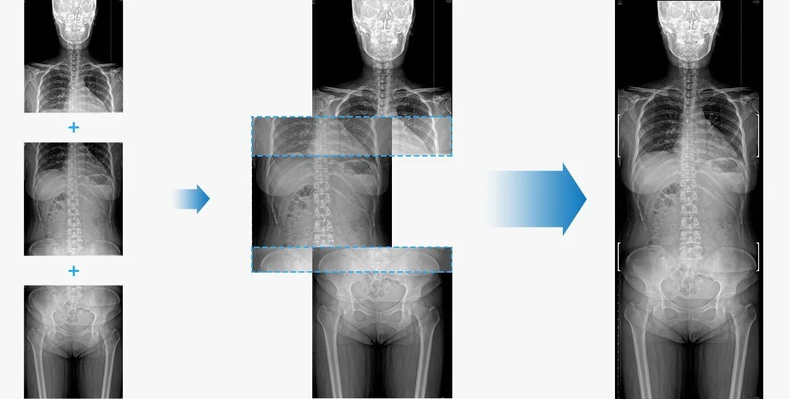 Аппарат рентгеновский диагностический цифровой передвижной gm85. Сшивка позвоночника рентгенография. Сшивка рентгеновских изображений. Планарное изображение рентгенография.