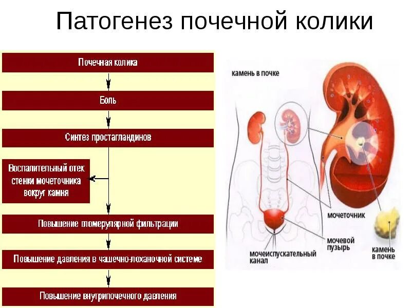 Мочекаменная болезнь почек этиология. Почечная гипертония патогенез. Почечная колика патогенез боли. Мочекаменная болезнь почек патогенез. Патогенез почки