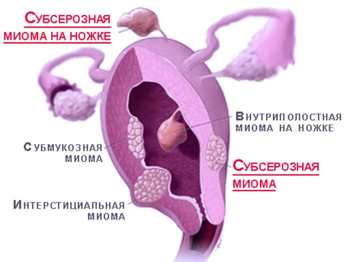 Миома на задней стенке матки. Субсерощная субмокощная интерстициальная миома матки. Субмукозный узел классификация. Субсерозный миомоматочный узел. Миома субсерозная субмукозная.