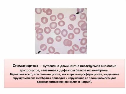 Аутосомно доминантная анемия