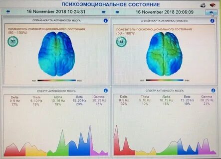 Биоэлектрическая активность мозга