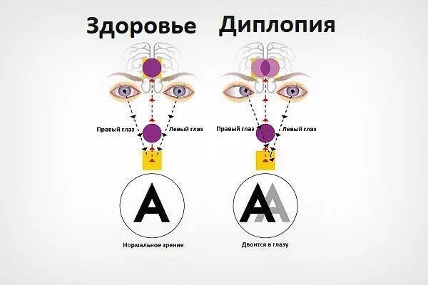 Двоение в глазах лечение. Бинокулярная диплопия причины. Двоится в глазах. Раздвоение объектов в глазах. Двоение предметов в глазах.