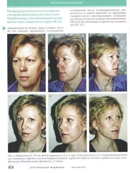 романчук алексей леонидович. семен лобанов. пластическая хирургия владивосток. пластика колумеллы носа. кшивец олег михайлович хирург.