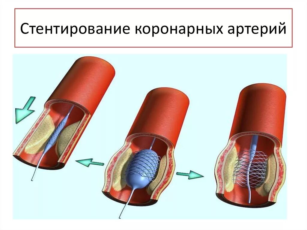 Аортокоронарное стентирование сосудов. Эндоваскулярное стентирование коронарных артерий. Стентирование коронарных артерий схема. Стент коронарного сосуда. Расширяет коронарные сосуды