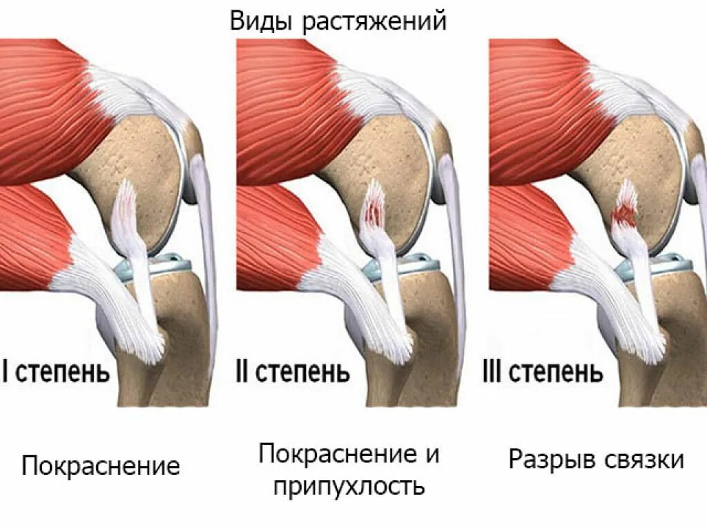 Лечение частичного разрыва мышц. Растяжение плечевого сухожилия. Растяжения и разрывы связок суставов. Разрыв связок плечевого сустава.