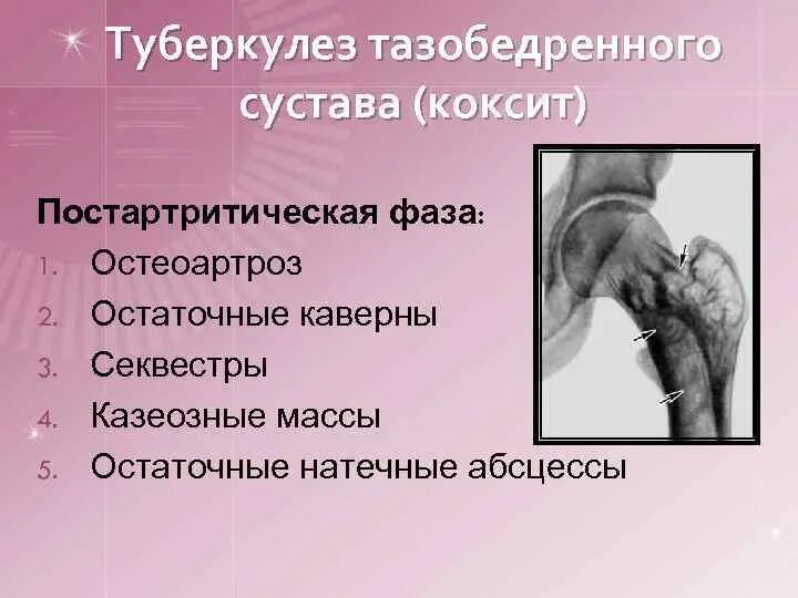 Туберкулез ноги. Туберкулез тазобедренного сустава. Постартритическая фаза туберкулеза. Туберкулез тазобедренных.