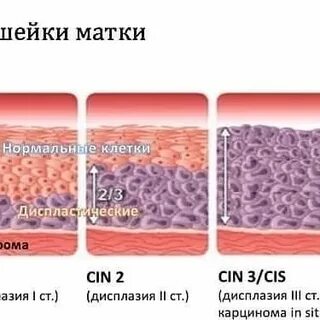 Неоплазия высокой степени шейки матки