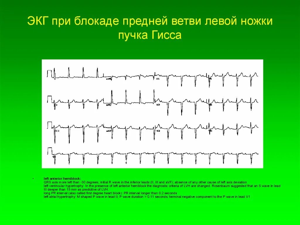 Нарушение блокады гиса. Блокада левой ножки на ЭКГ. ЭКГ при блокаде левой ножки пучка. ЭКГ при блокаде задней ветви левой ножки. ЭКГ ЭКГ при блокаде передней ветви левой ножки.