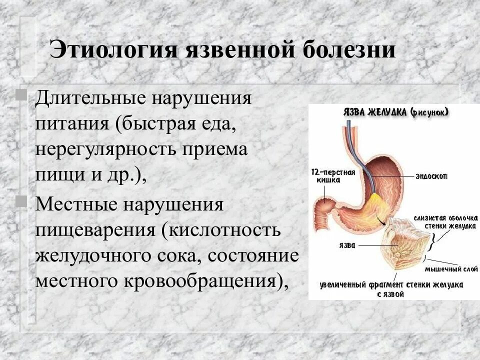 Кислотность желудка язва желудка. Этиология язвенной болезни. Этиология язвенной болезни желудка. Желудок и желудочный сок. Кислотность при язвенной болезни желудка.