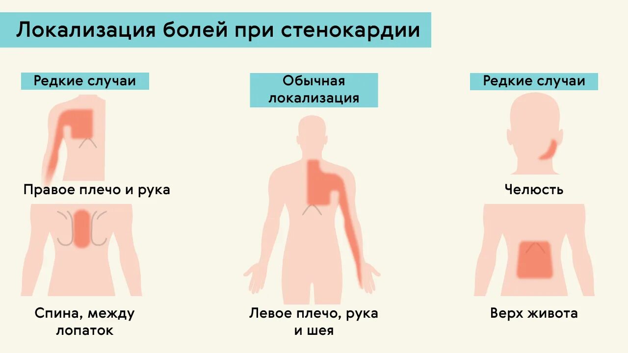 Причины стенокардии у мужчин. Локализация боли при стенокардии. Типичная локализация боли при стенокардии. Локализация боли в сердце. Локализация боли в груди.