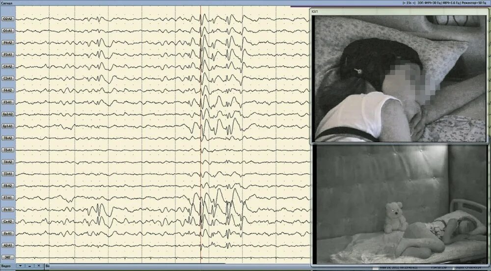 ЭЭГ мониторинг ночного сна. ЭЭГ видеомониторинг сна. ЭЭГ ночной сон видеомониторинг. ЭЭГ мониторинг сна у детей. Ээг дневное ребенку