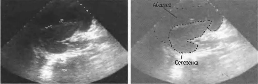 Абсцесс селезенки эхограмма. Спленомегалия селезенки УЗИ. Инфаркт селезенки УЗИ картина. Распад селезенки