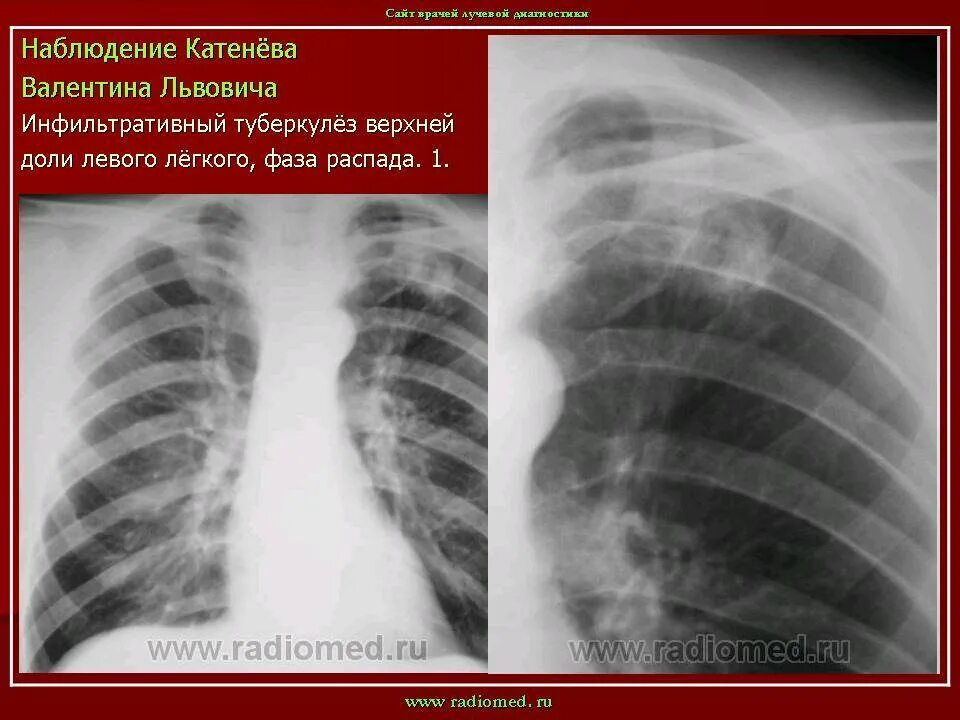 Инфильтративный туберкулез s1 s2. Инфильтративный туберкулез рентгенография. Инфильтративный туберкулез s1-2 правого легкого. Очагово-инфильтративный туберкулез рентген.