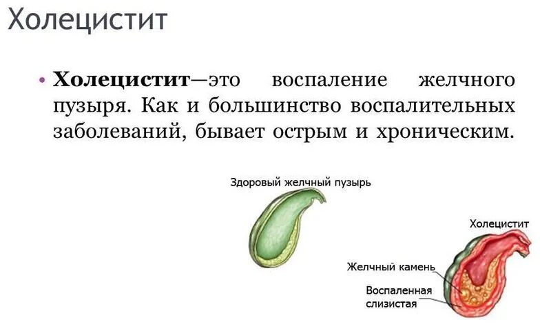 Настойка желчного пузыря. При воспалении желчного пузыря. Острый и хронический холецистит. Хронический холецистопанкреатит. Холецистит воспаление.