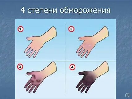 Повязка при обморожении