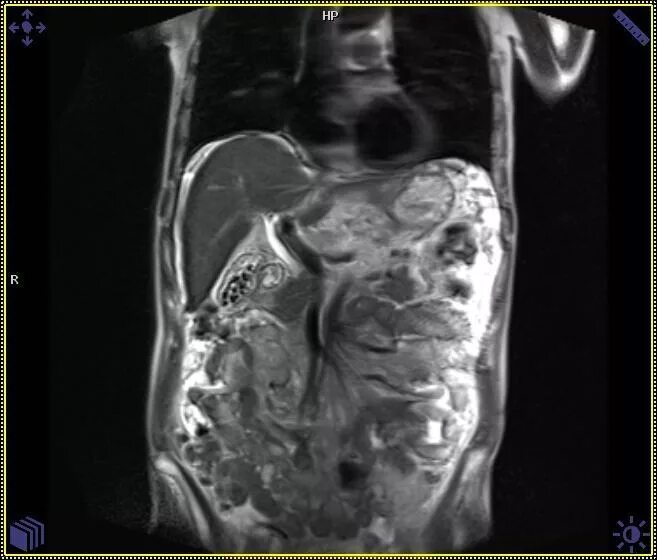 холангиография желчные протоки мрт. холангиография желчных протоков рентген. кт анатомия желчных протоков. мрт желчных протоков холангиография. магнитно-резонансная холангиография желчного пузыря.